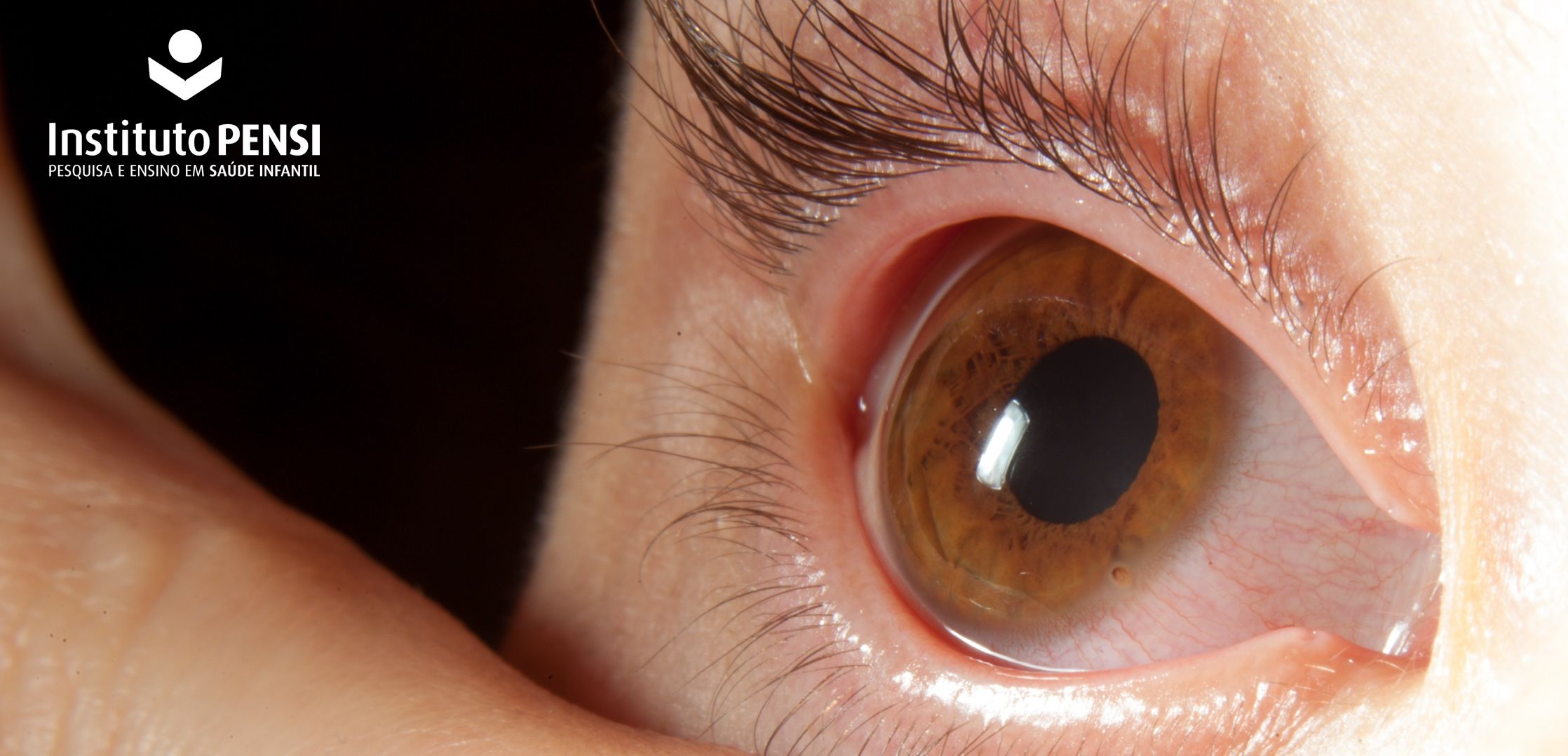 Abrasão na córnea: como lidar e evitar esse incômodo?