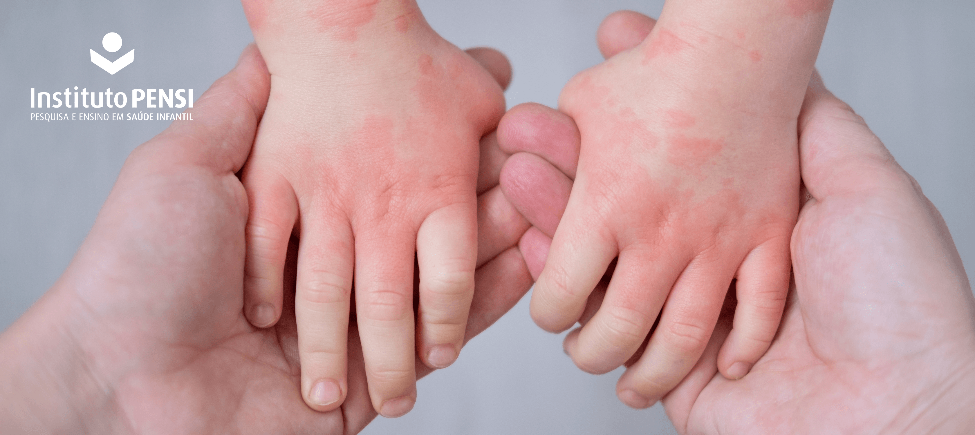 Como saber se meu filho é alérgico a algum medicamento?