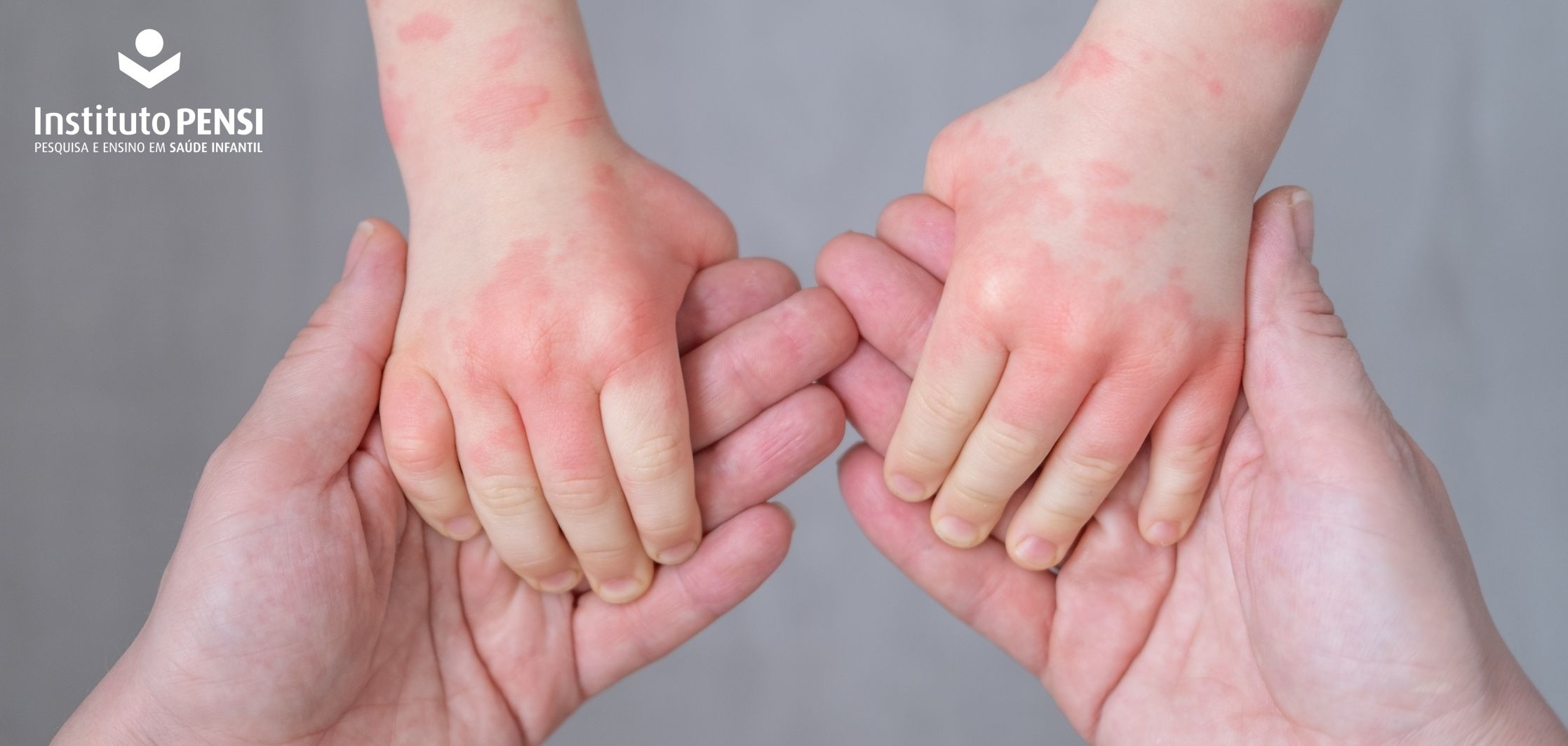 Alergia à penicilina relatada pode não ser alergia à droga