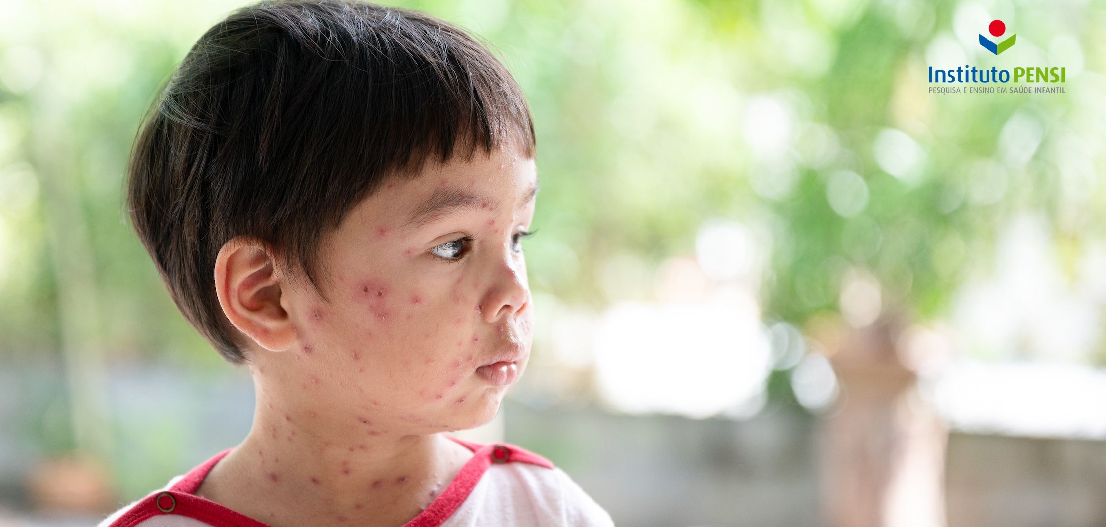 Catapora não é doença “do bem”