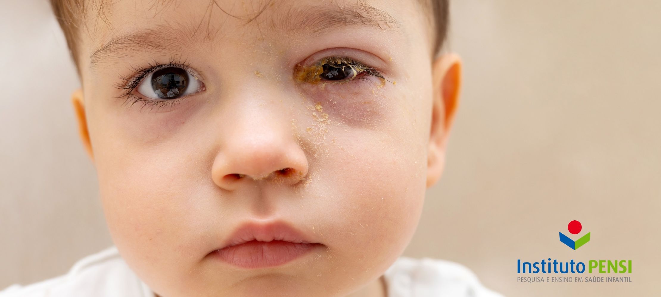 Cuidados e tratamentos para a conjuntivite