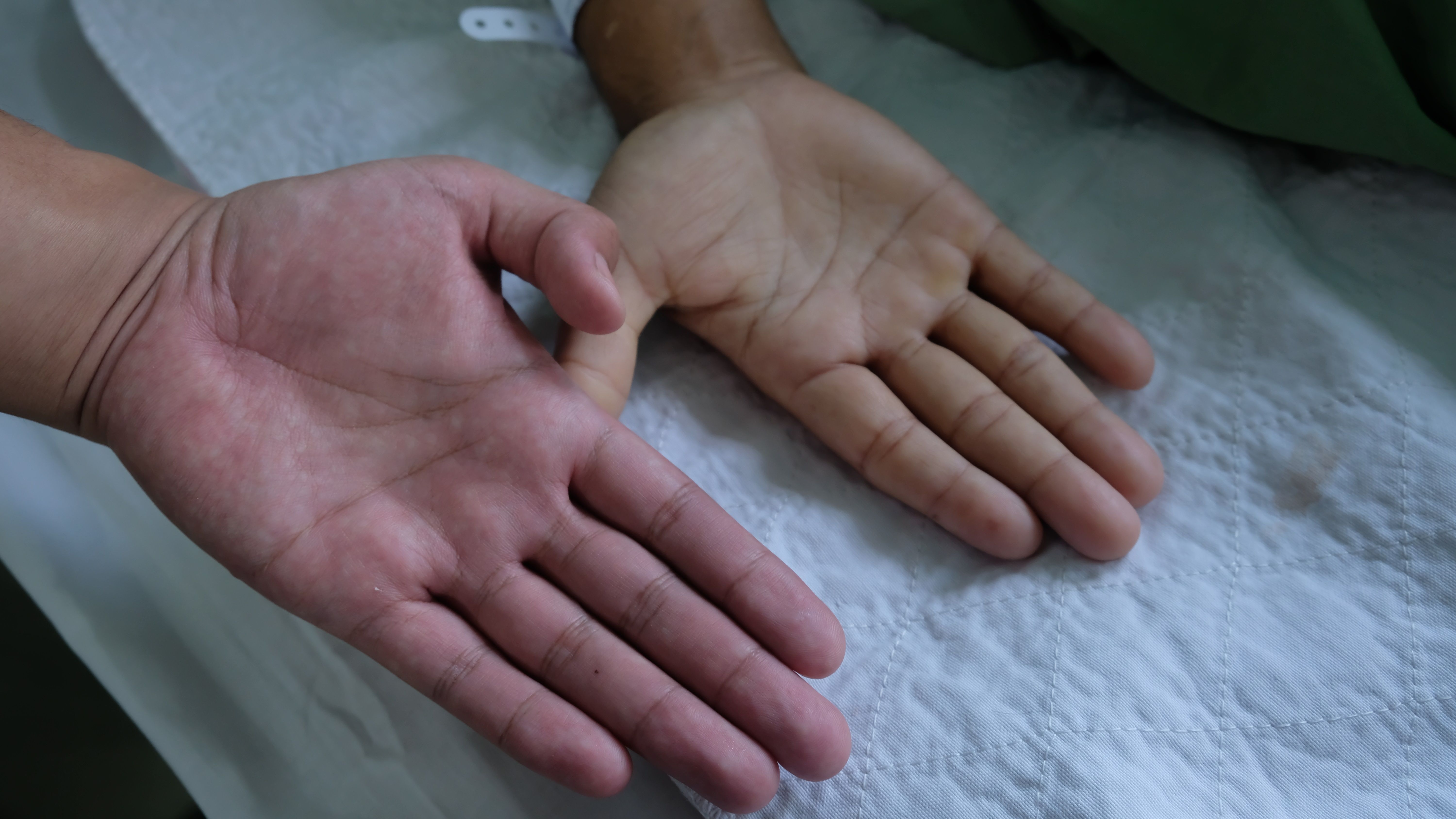 Dia Mundial de Conscientização sobre a Doença Falciforme