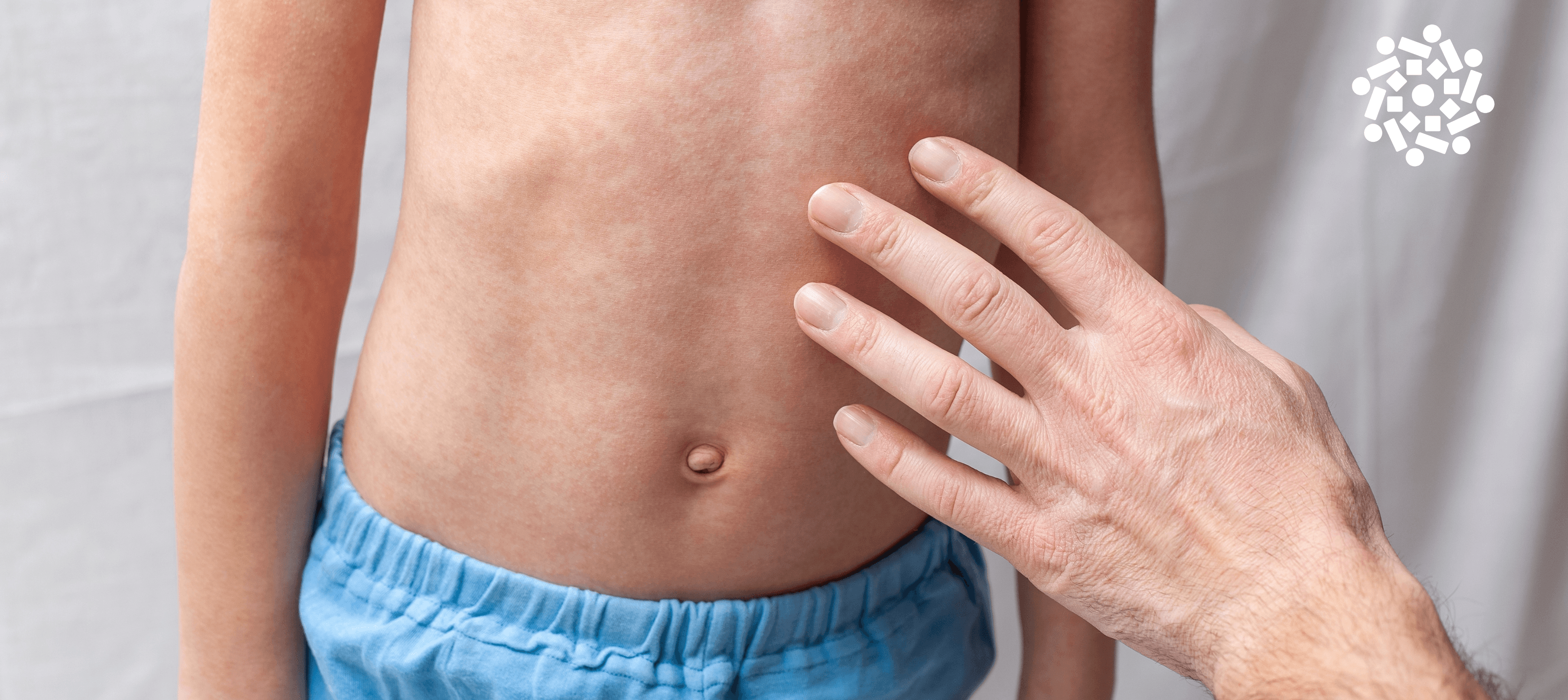 Escarlatina: o que os pais precisam saber?