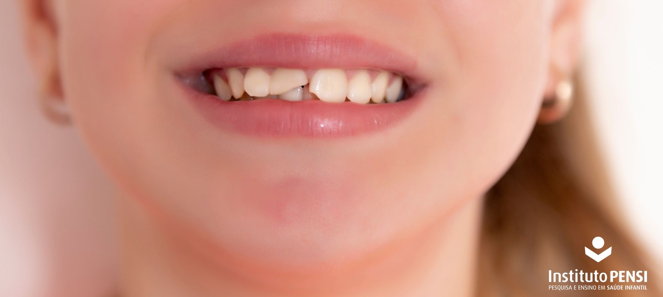 Saúde bucal infantil: o que fazer quando uma criança machuca a boca?