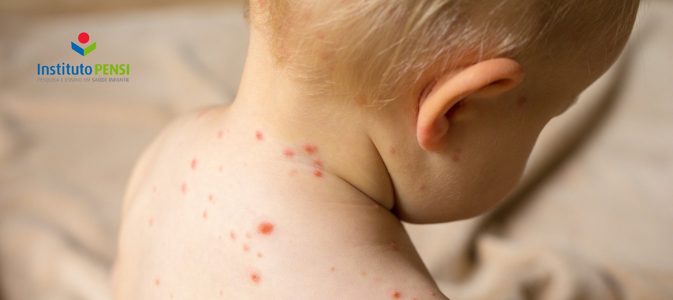 Varíola dos macacos, vamos falar dela novamente