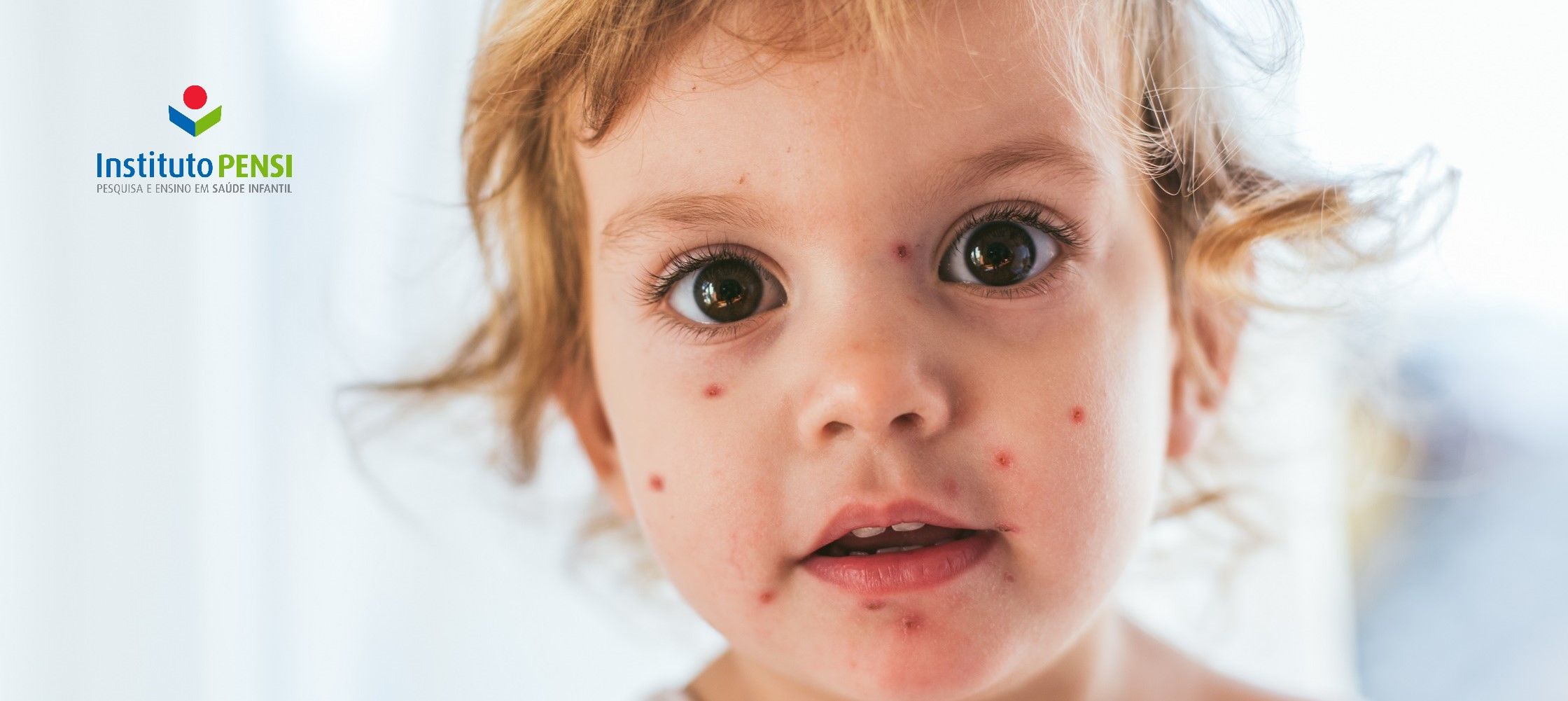 Agora é a vez da catapora