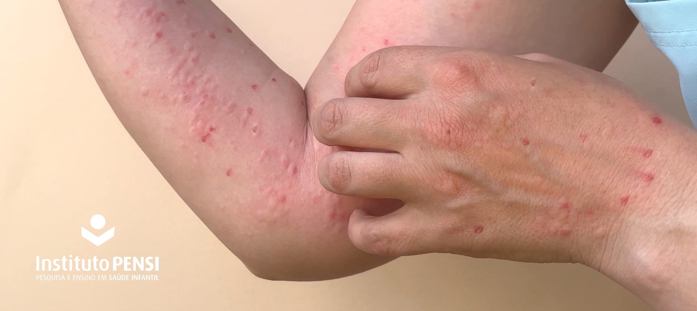 A volta da Varíola dos Macacos (Mpox)