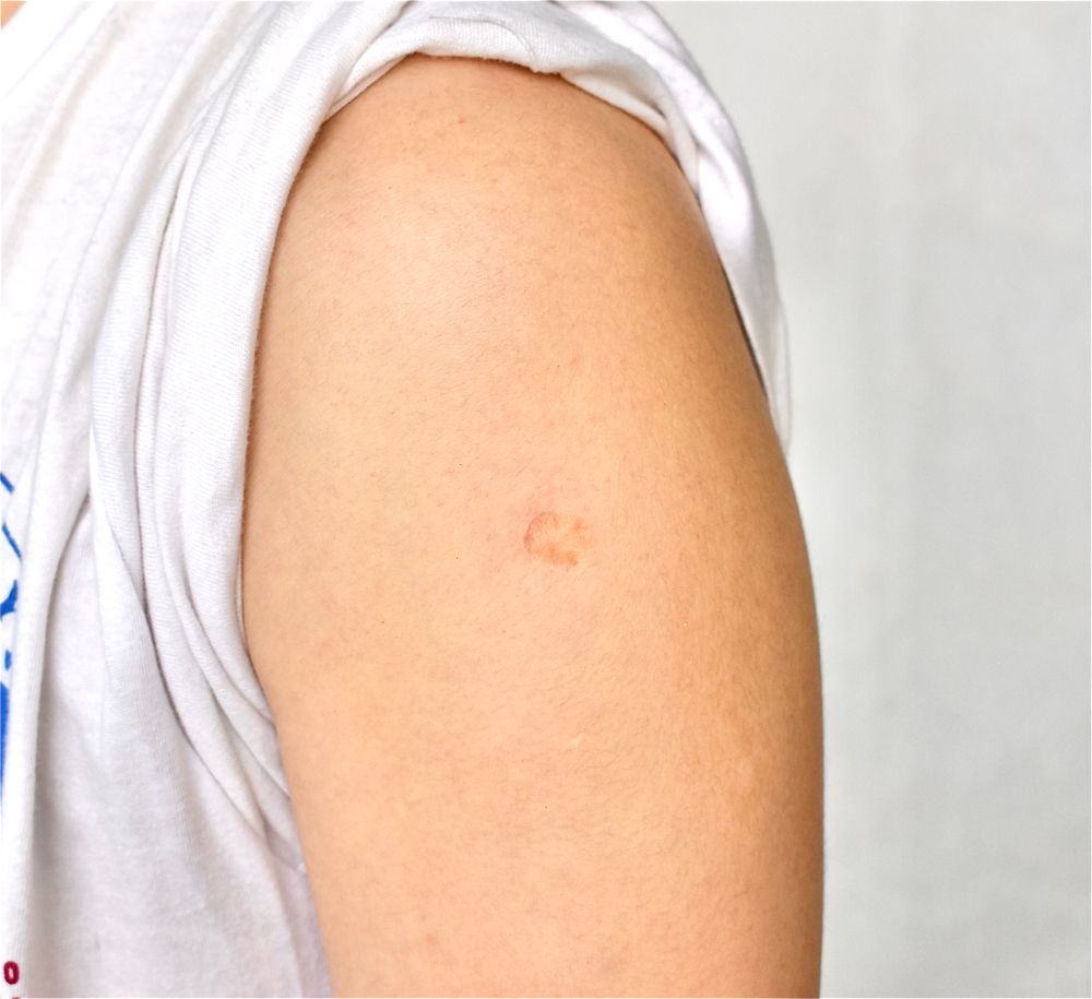 Vacina BCG: entenda a importância para a saúde das crianças