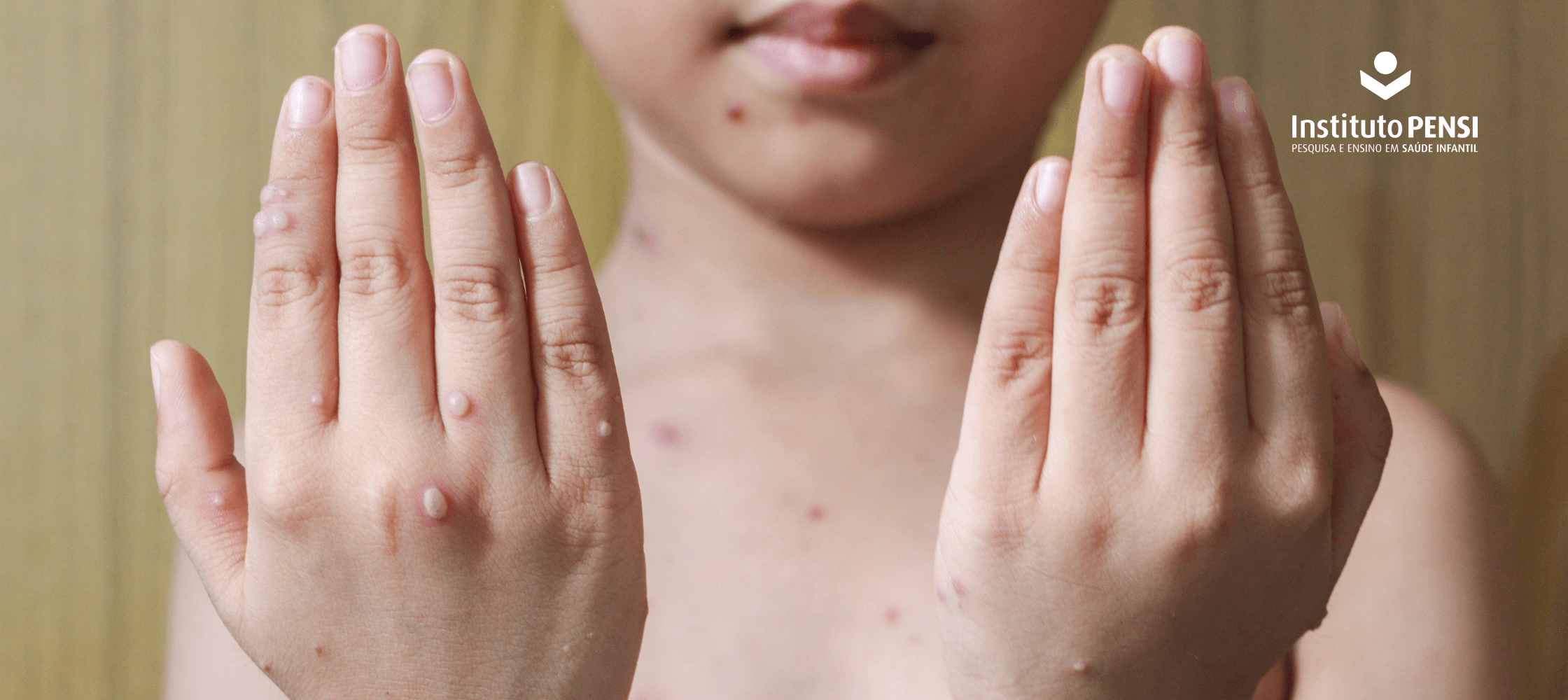 O que é a varíola dos macacos? Pode dar em crianças?